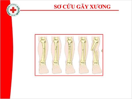 Tài liệu hướng dẫn cách phòng chống tai nạn thương tích, đuối nước - Bài 3: Sơ cứu cố định xương gãy